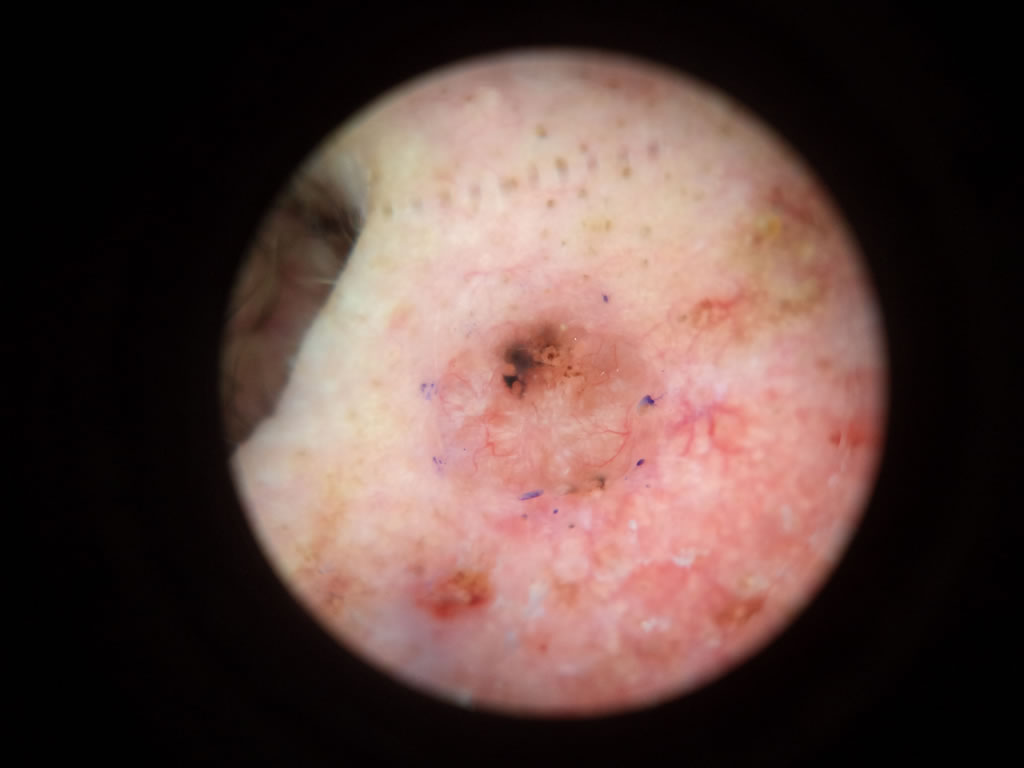 Basal Cell Carcinoma  ( BCC )