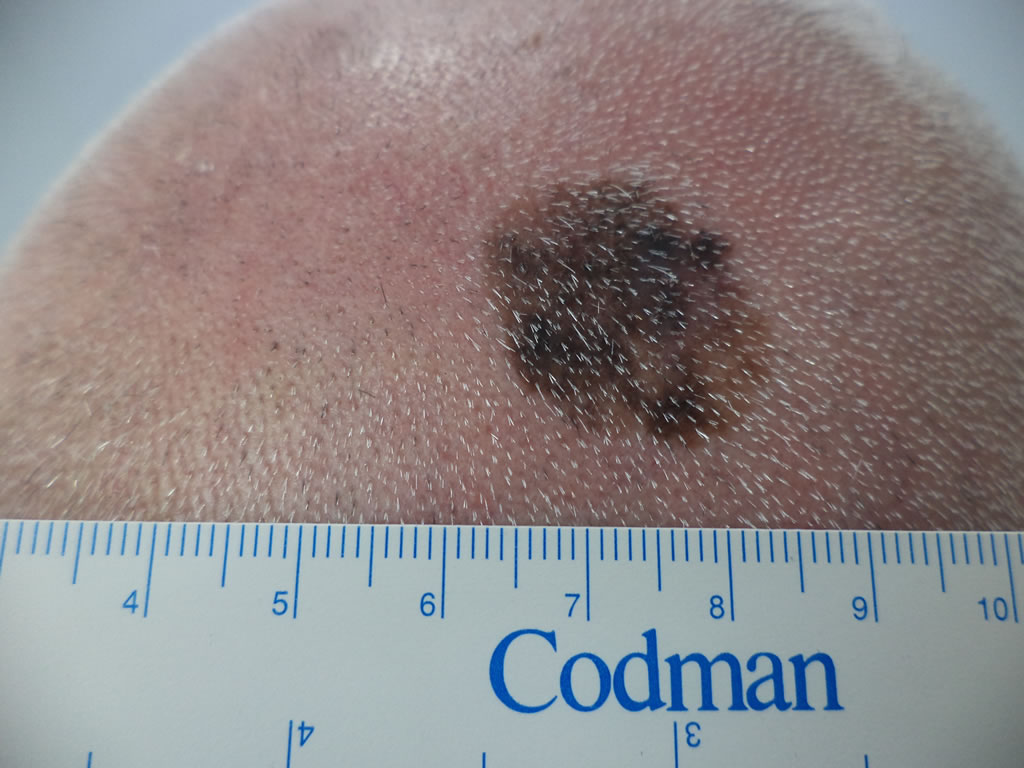 Melanoma