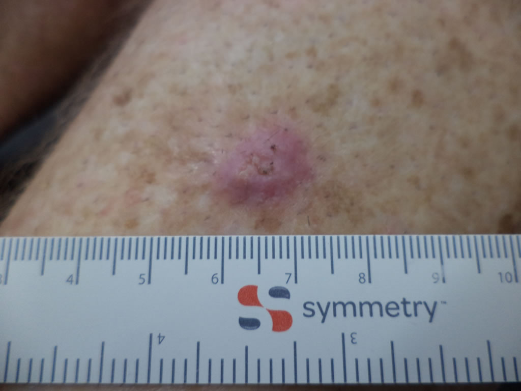 Squamous Cell Carcinoma ( SCC )